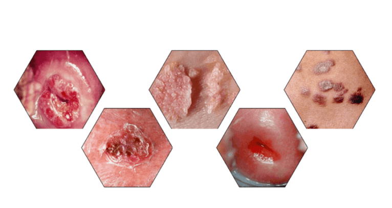 Zašto su papilomi opasni