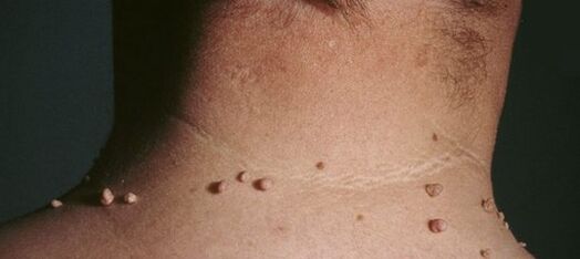 kako se riješiti papiloma