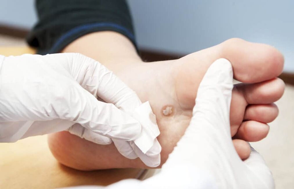 zašto se bradavice pojavljuju na tijelu