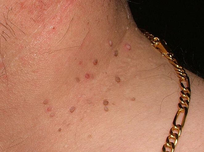 Papilomi na vratu