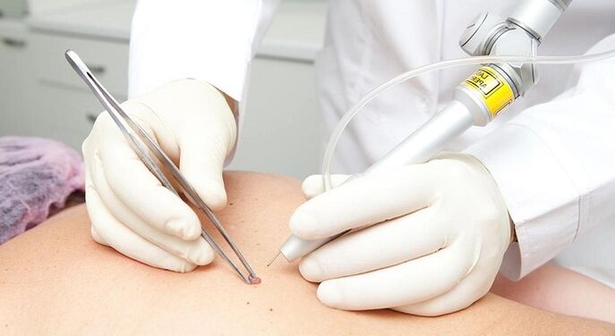 lasersko uklanjanje papiloma za papilomavirus