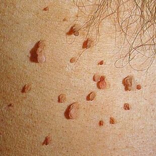 Papilomi često rastu u kolonijama i mogu se pojaviti na koži cijelog tijela